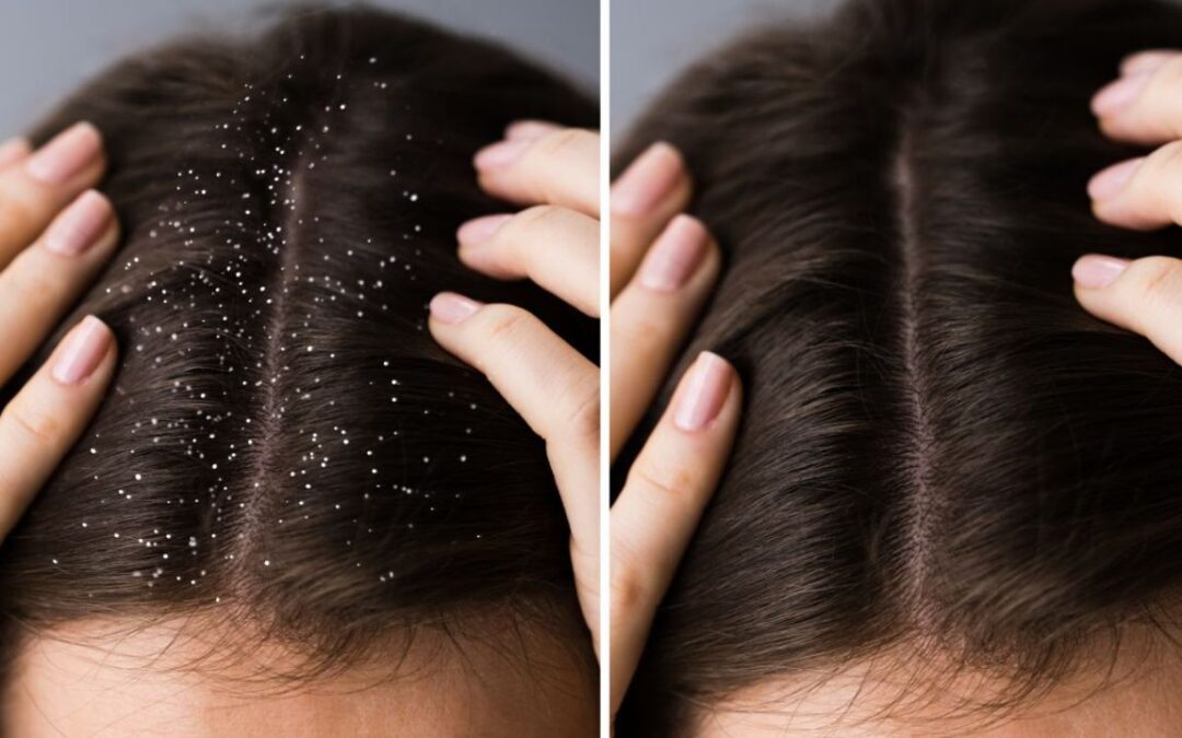 Forfora sul cuoio capelluto? Ecco come gestirla.