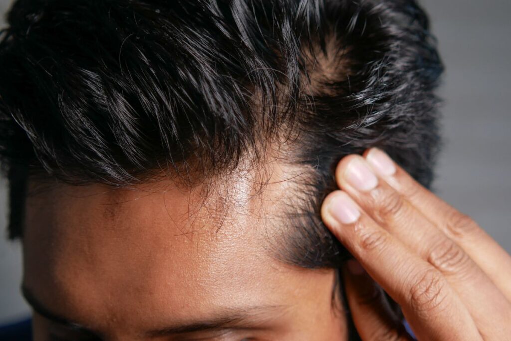 Primo piano dell'attaccatura dei capelli di un uomo mentre solleva la chioma con le dita